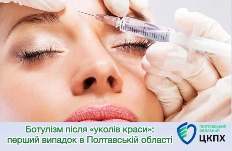 Ботулізм після ін’єкції ботулотоксину на Полтавщині