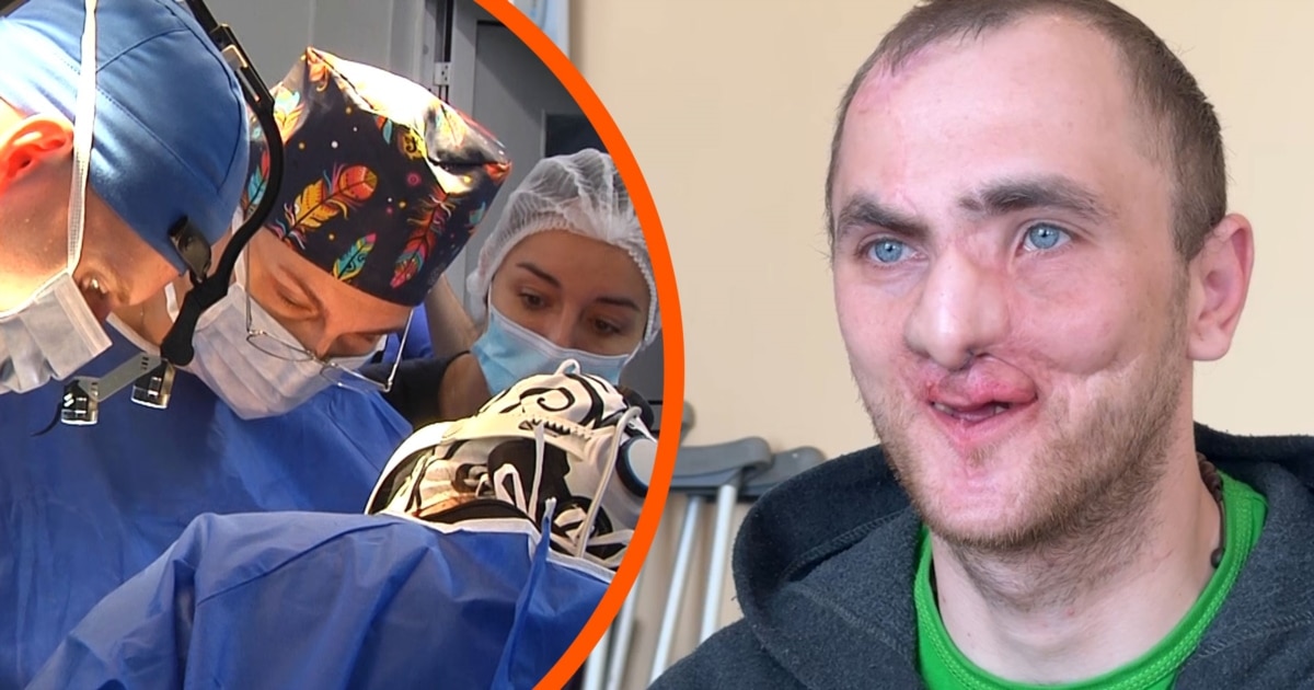 Втратив пів обличчя на війні, шансу виправити не було: історія …