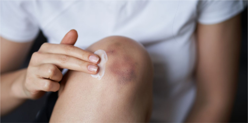 Дивні синці на тілі: луцька лікарка розповіла, коли варто бити …