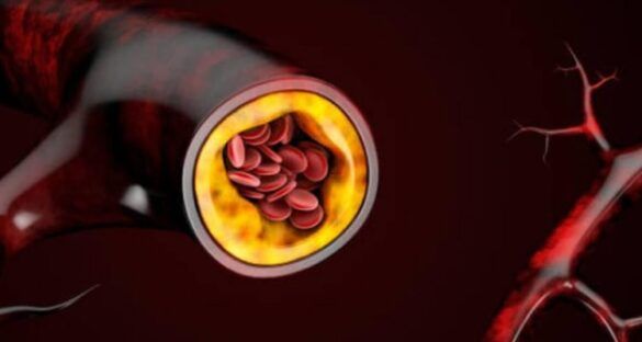 Жир проти цукру: який продукт більше шкодить рівню холестерину