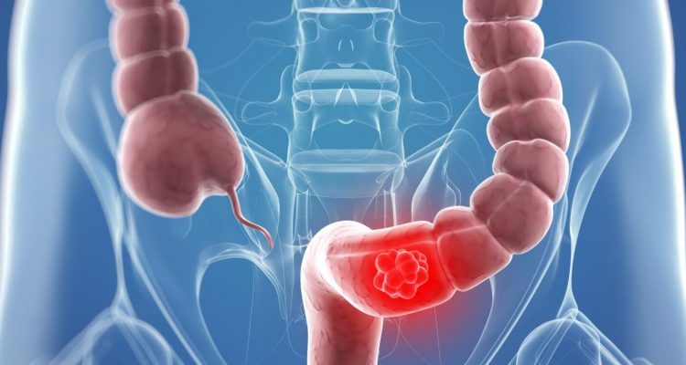 Рак кишківника: виявлено нову ознаку захворювання