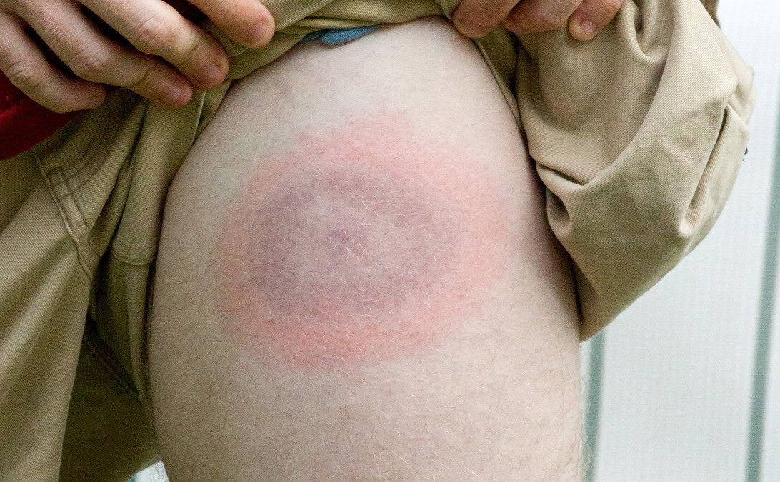 У Полтавській області набирає обертів хвороба Лайма