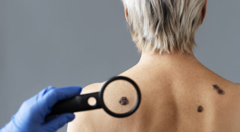 У Рівному можна безкоштовно перевірити родимки