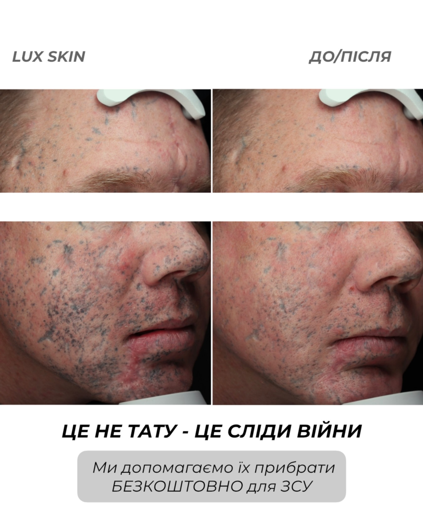 Франківська клініка безкоштовно видаляє порохові татуювання воїнам: історія одного пацієнта …