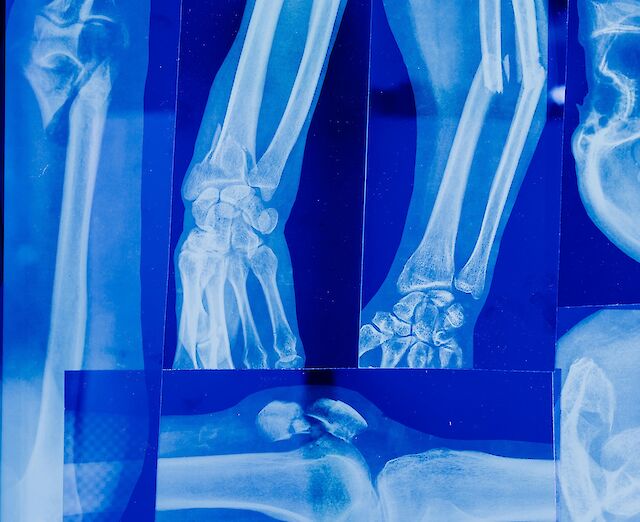 Як захистити кістки після 50: поради лікарів щодо профілактики остеопорозу …