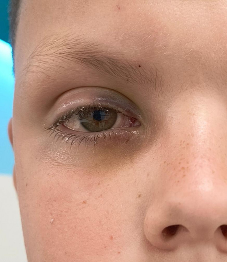 На Львівщині під час риболовлі гачок пробив повіку 12-річному хлопчику