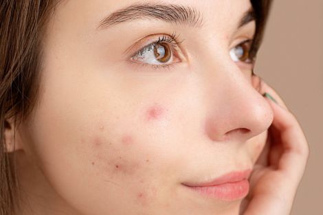 Що робити зі шкірою, коли у вас розширені пори